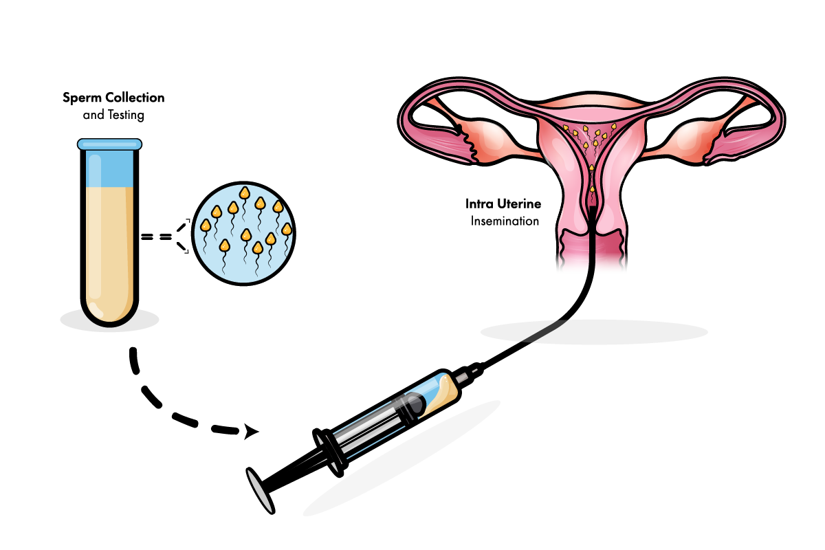 double IUI process
